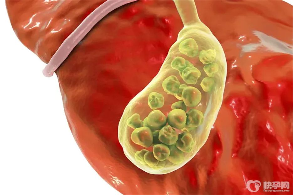 女性胆囊炎是什么原因引起的？多半与7个因素有关