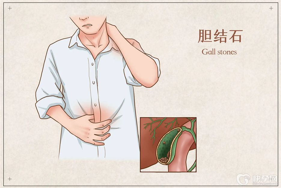 胆结石的症状有哪些？身体会发出这6个求救信号