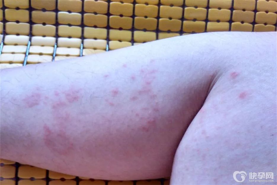 健康指南：新生儿湿疹怎么好得快？做好这六点是重中之重