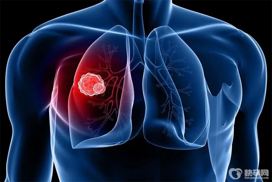 健康科普：盘点早期肺癌的6大症状，早发现能救命