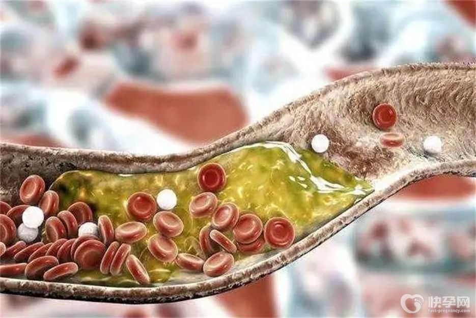 健康科普：甘油三酯高是什么原因？这四大因素是罪魁祸首