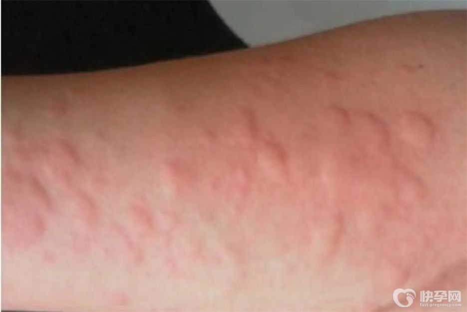 荨麻疹吃什么水果最好？这六种水果是不错之选