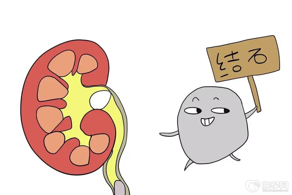 尿结石患者禁食11种食物，一定要牢记切勿粗心大意