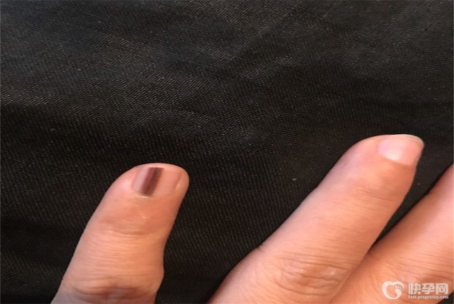 手指甲出现竖黑条纹是怎么回事？多半是这七个原因在作怪