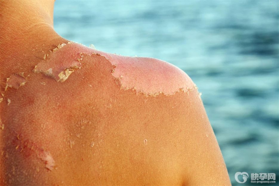 晒伤了皮肤红痛怎么办？做好这七点至关重要