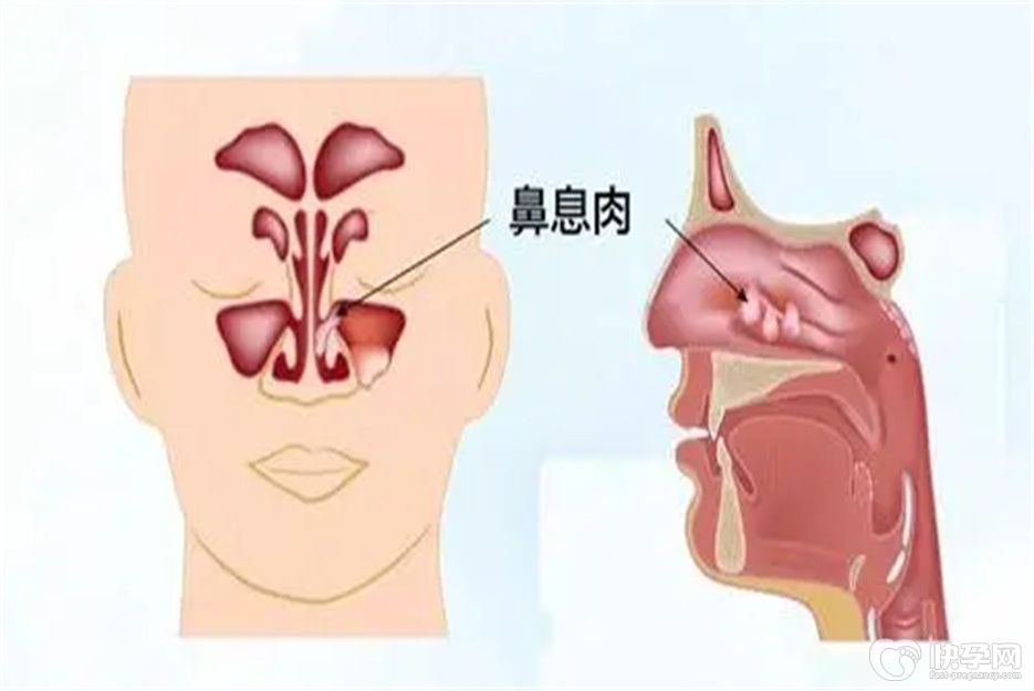 鼻息肉有什么症状表现？身体会出现这6个异样
