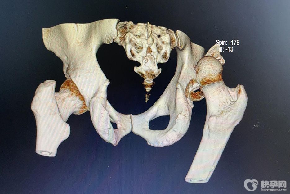 髋关节后脱位的典型体征是什么，出现这5大表现需及时就医治疗