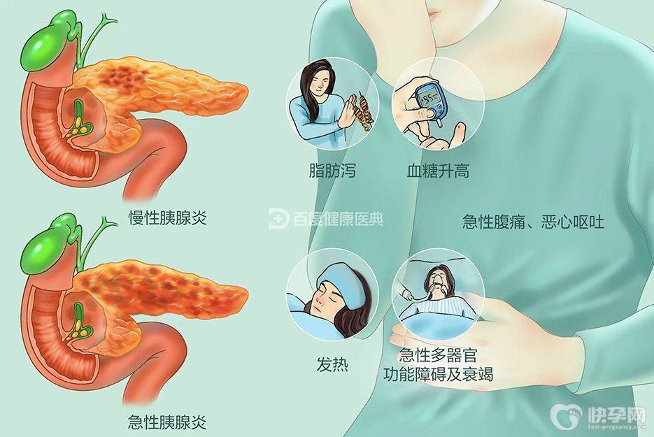 科普慢性胰腺炎的4大症状，看看你有没有这些表现