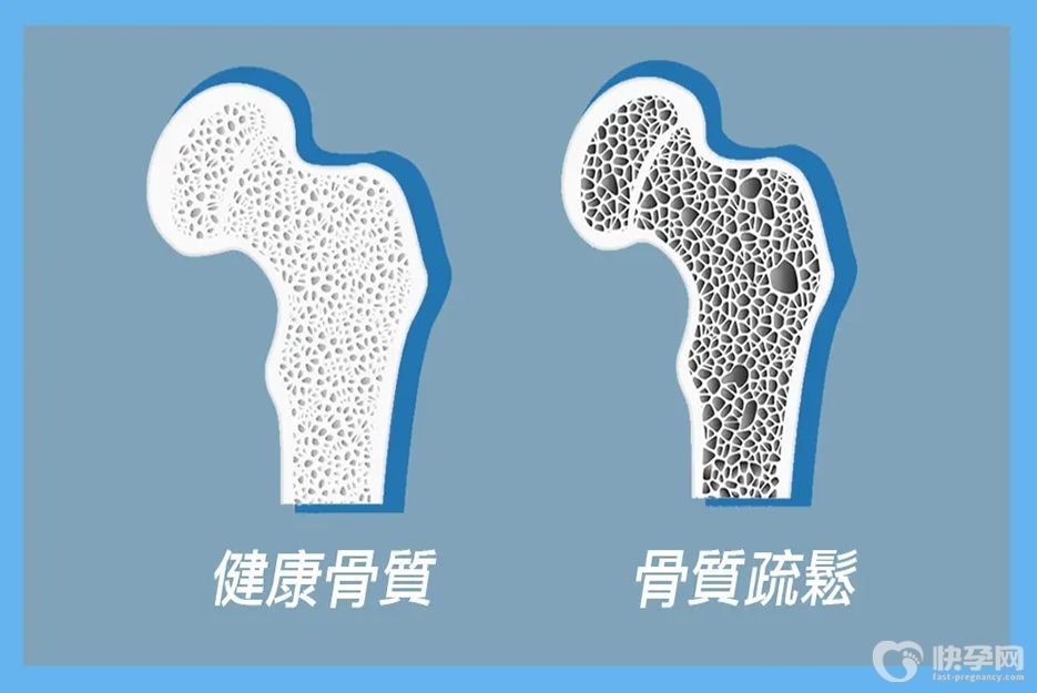 骨质疏松三种水果不能吃！请尽早拉入黑名单