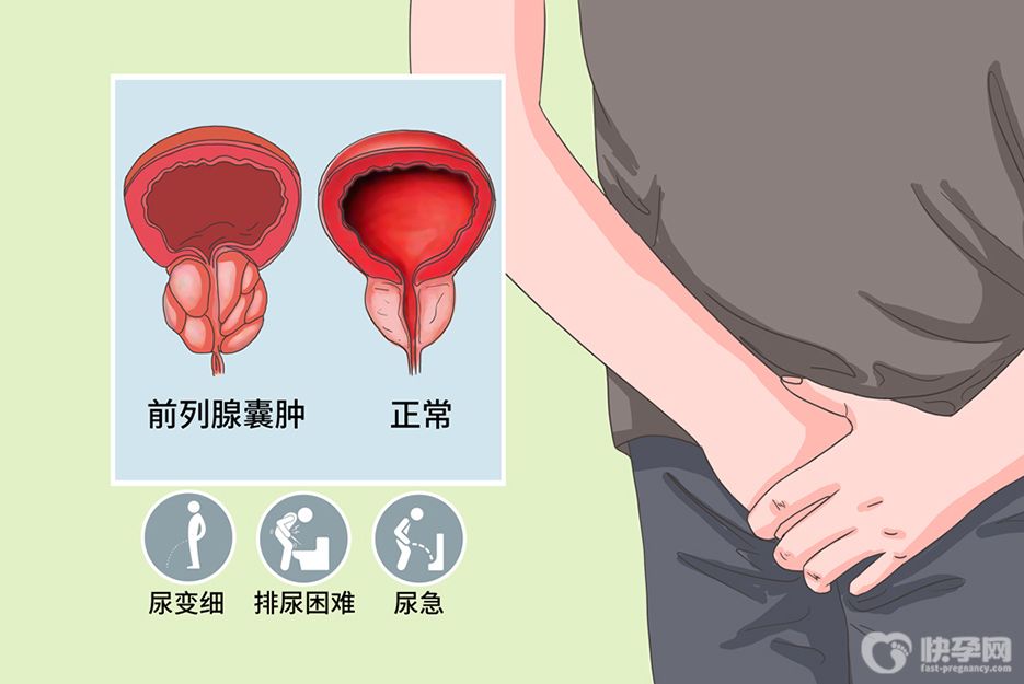 前列腺囊肿是什么原因？这4大危险因素要警惕