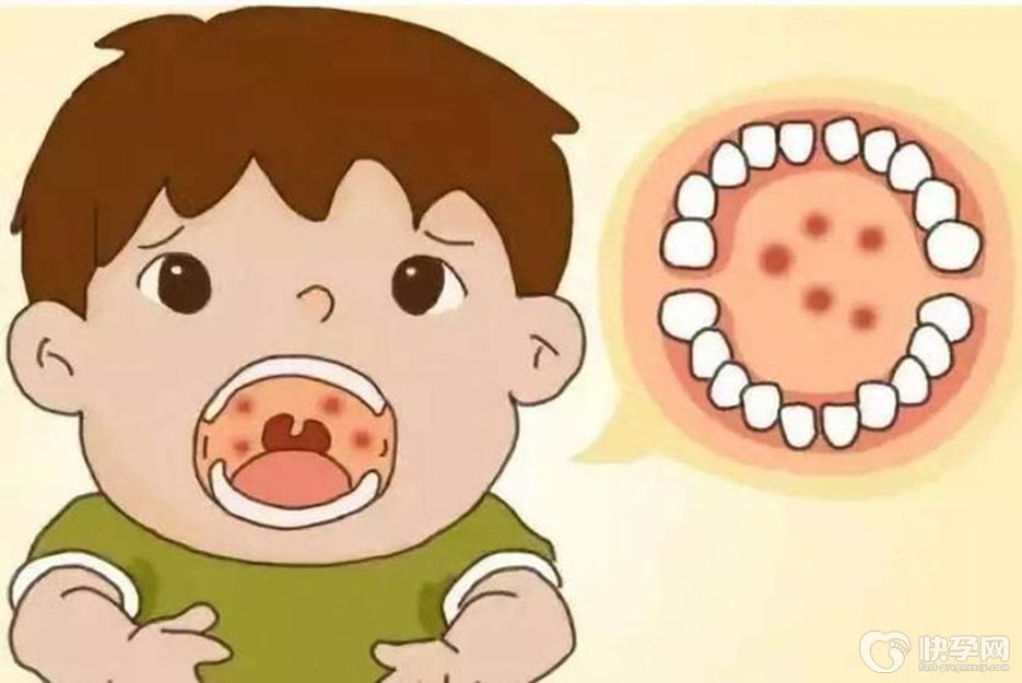 咽颊炎的5大症状表现，赶紧进来了解一下吧