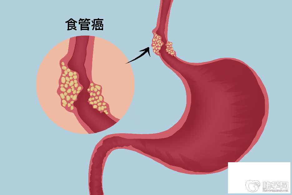 科普食道肿瘤扩散的前兆，你需要时刻留意