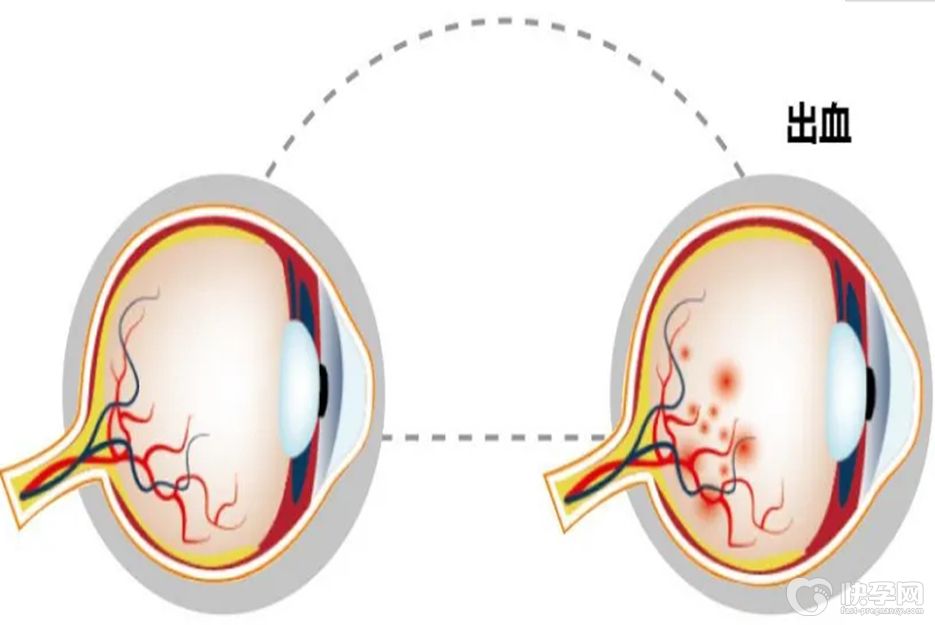 眼底出血最佳治疗方法，及时就医才是治疗关键