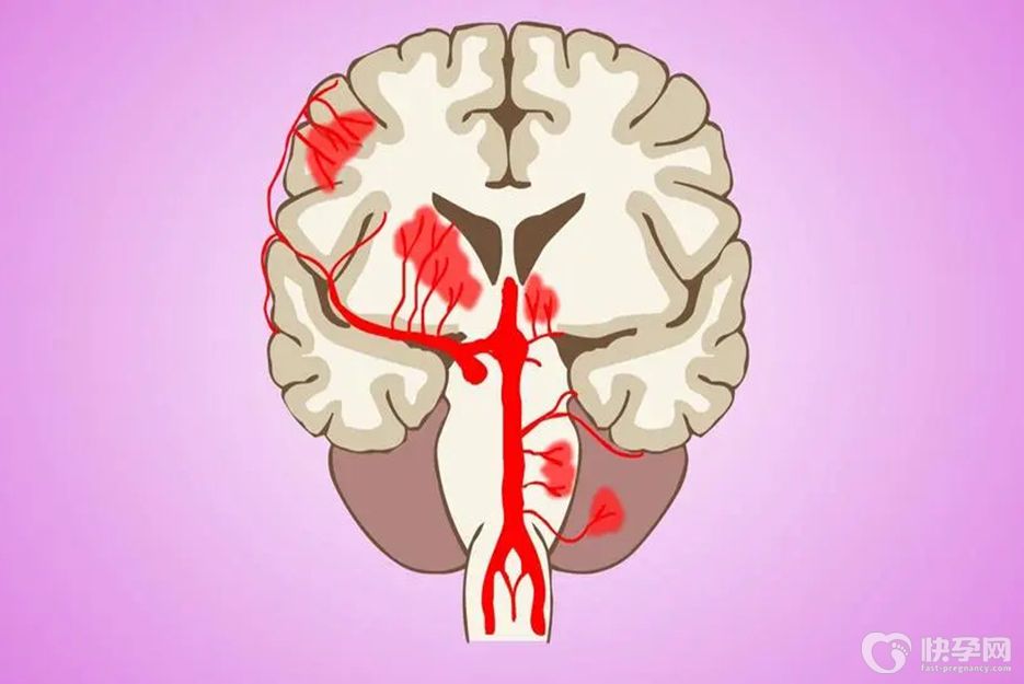 丘脑出血多久过危险期，警惕二次出血威胁生命安全