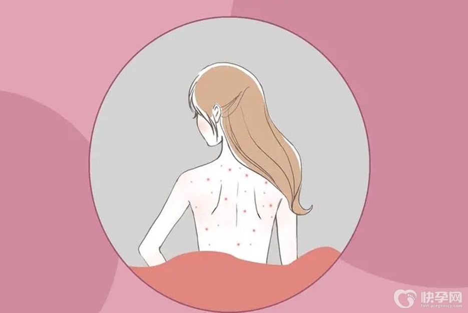 后背长痘痘是什么原因？看到这4个原因，就不足为奇了