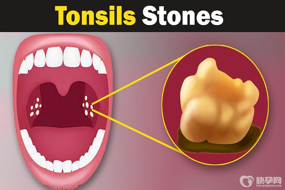 扁桃体结石脱落小妙招，不要轻易的切除扁桃体
