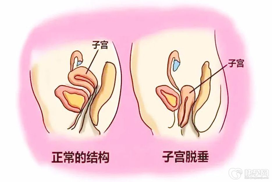 怎么治疗子宫脱垂最快？5种常见方式应按需选择