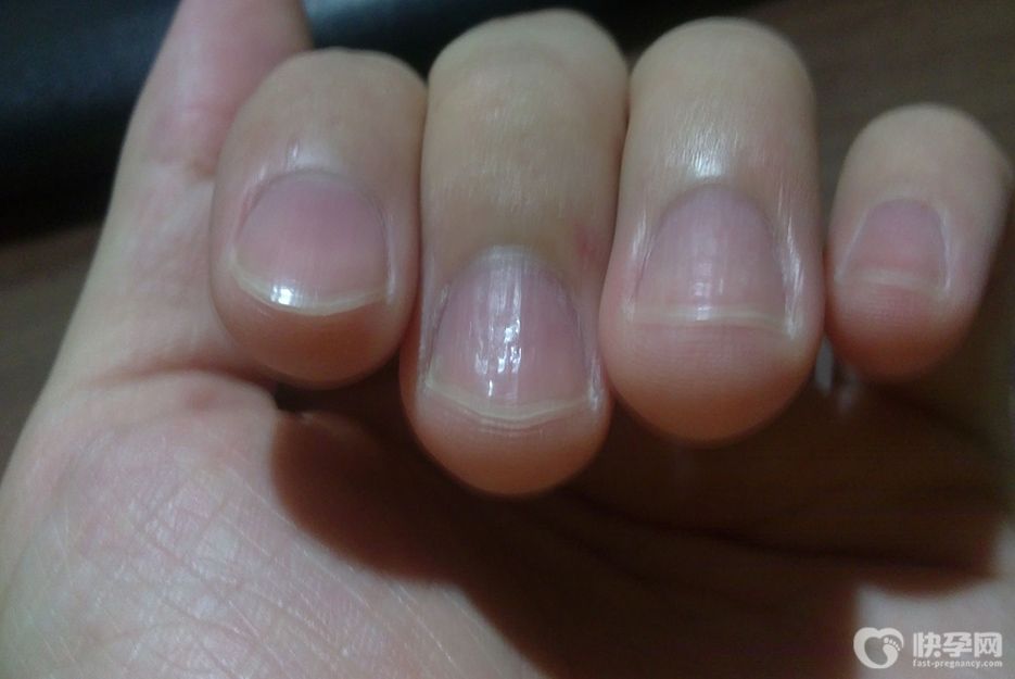 指甲凹凸不平是什么原因？原来是这四大祸首在作怪