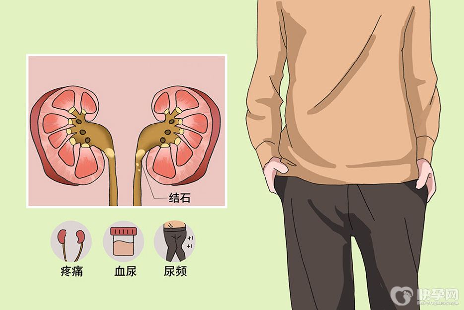 尿结石有哪些症状表现？附尿结石的4大常见症状