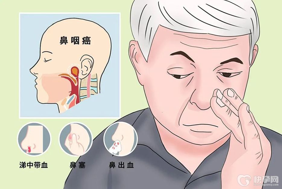 鼻炎癌早期有什么症状？盘点鼻炎癌早期症状表现