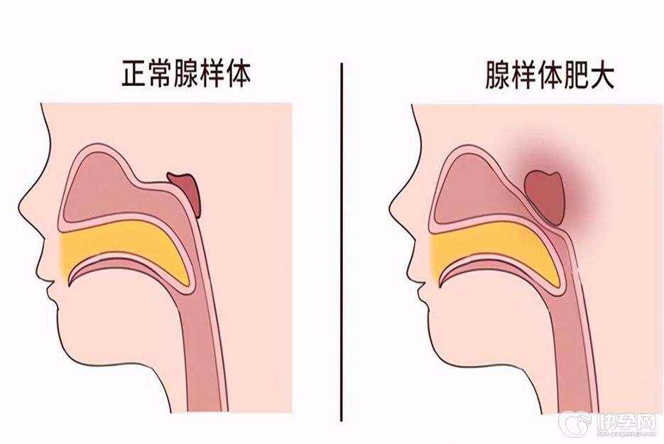 腺样体肥大的孩子必须做手术吗？不一定，遵医嘱治疗即可