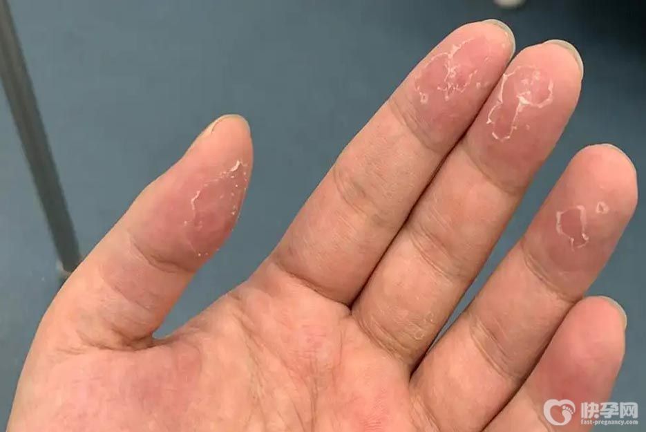 手指脱皮快速恢复方法，5个改善方法拿走不谢