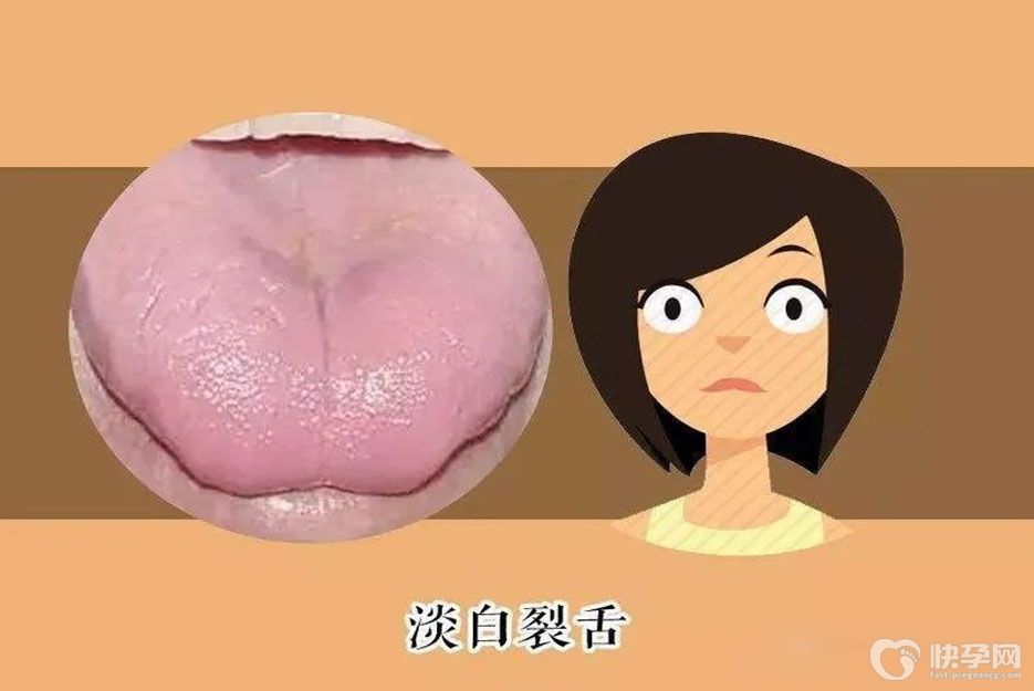 舌头上有裂纹是什么原因？6种原因可导致裂纹舌