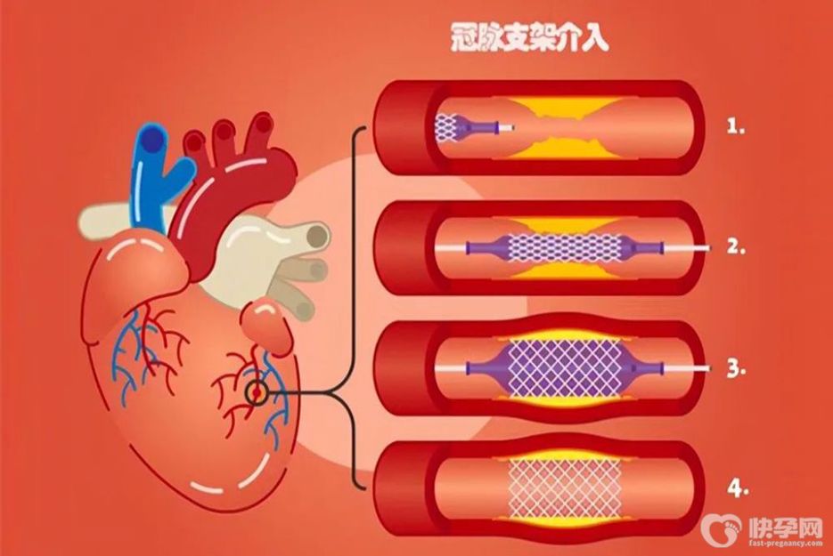 心脏支架后最怕三件事，如果你有，必须马上改正