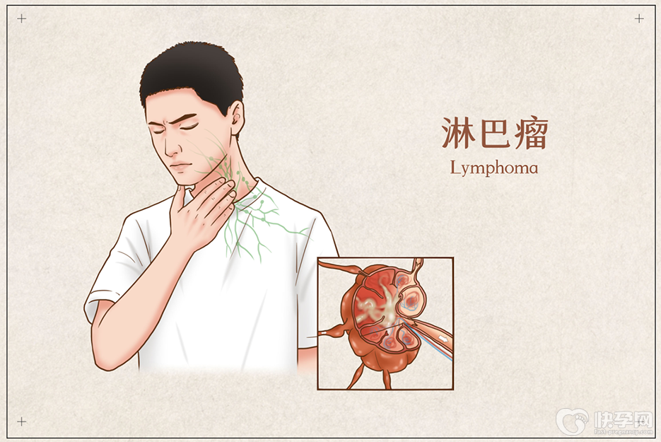 大腿淋巴癌早期症状，3个典型表现会提示你