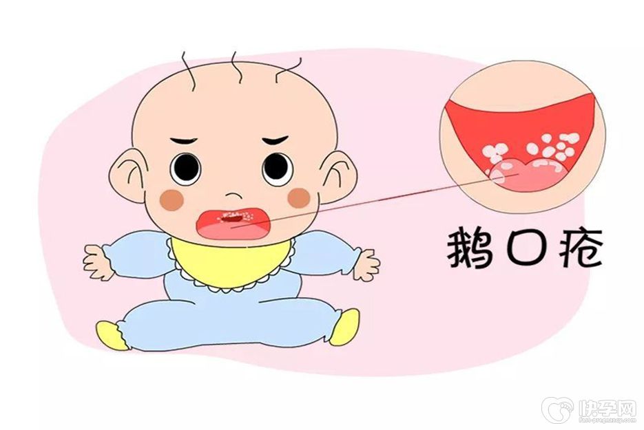 鹅口疮自愈的最好办法，4个治疗方式供选择