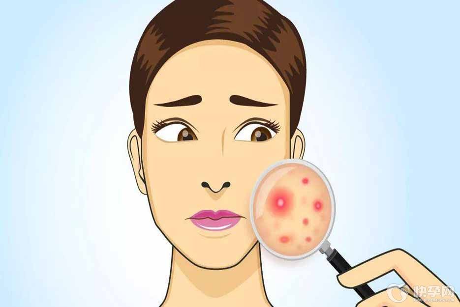 痤疮最怕三种食物，辛辣、腥发、高糖类食物应忌口