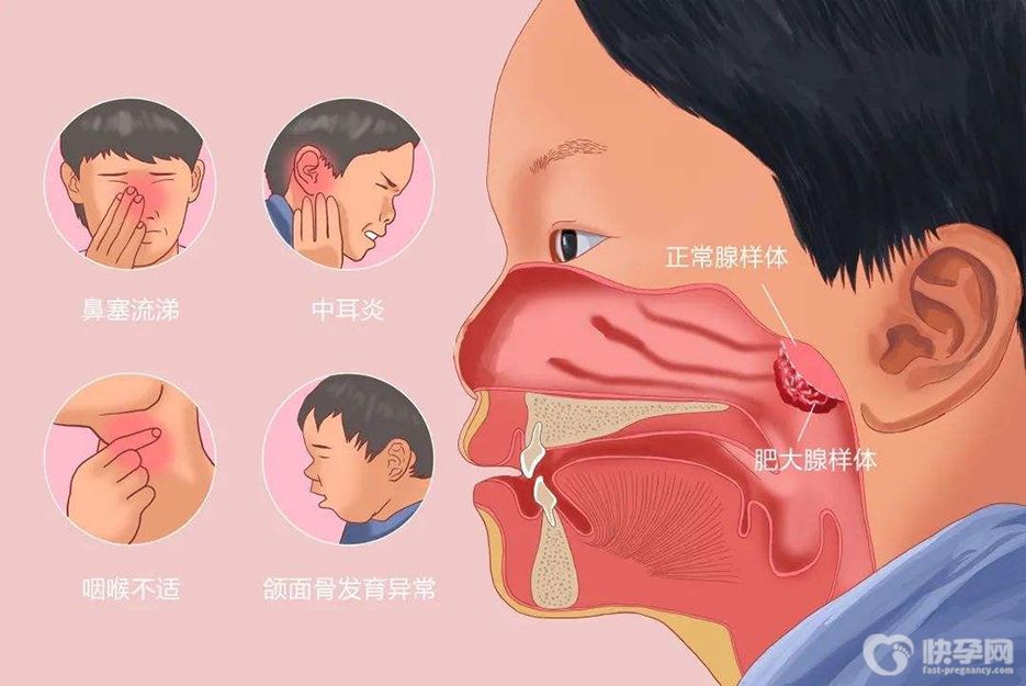 腺样体肥大引起的咳嗽特点，剖析腺样体肥大的4个表现