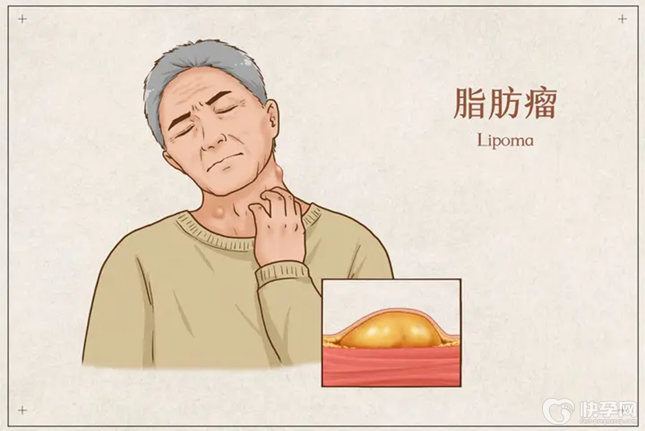 分享脂肪瘤3个办法消退，根据自身情况进行选择