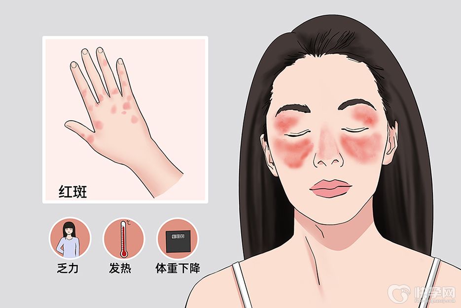 红斑狼疮最怕的三样东西，最好敬而远之，别不管不顾