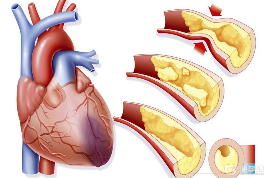 心肌梗塞是什么原因引起的？这5大原因值得反省一下