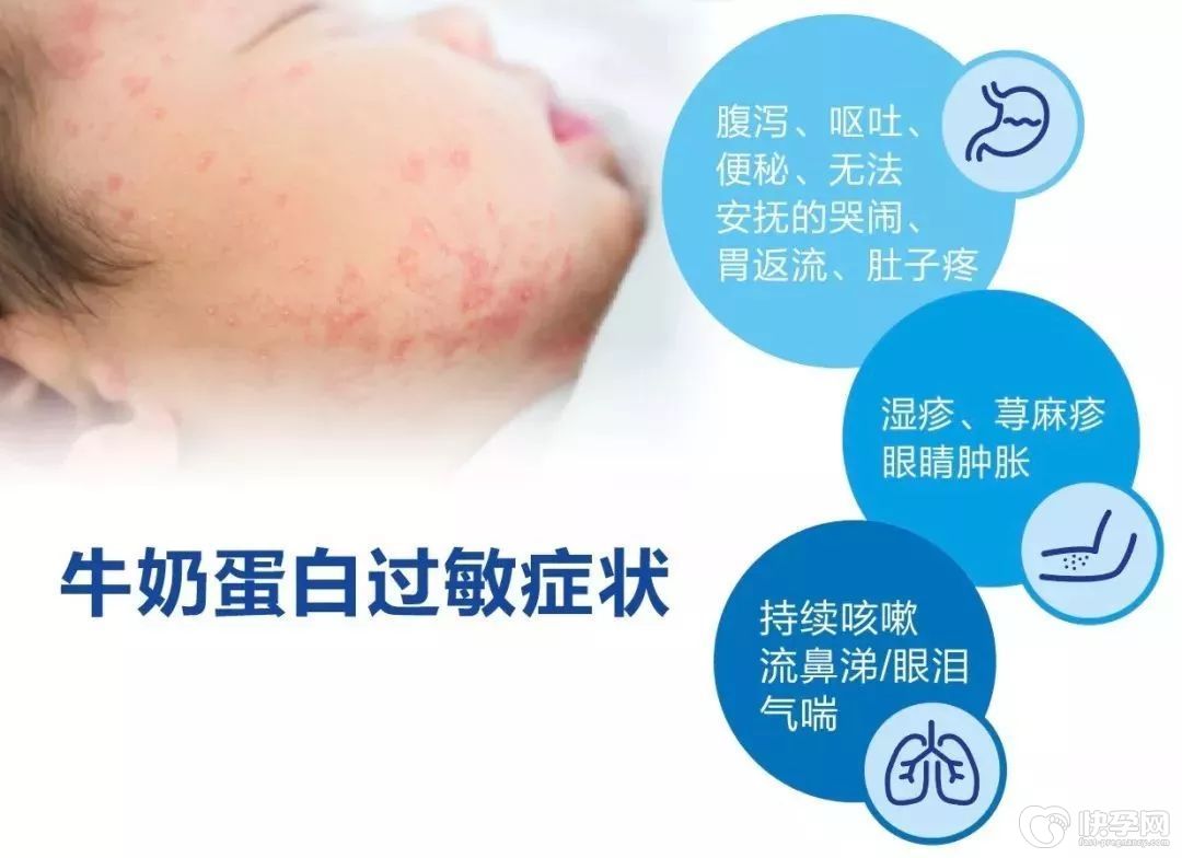 宝宝牛奶过敏有哪些症状？宝宝牛奶过敏要怎么办？