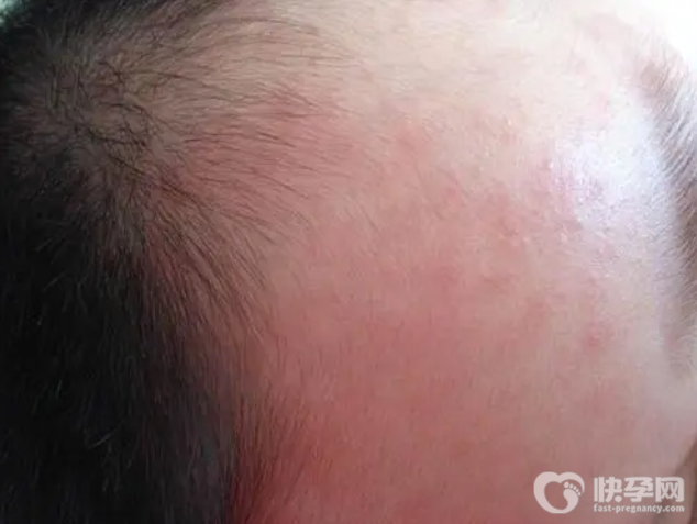 发热后出疹子别大意，这五种疾病要警惕！