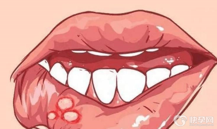 口腔癌早期的6个特征，口腔癌的早期典型症状