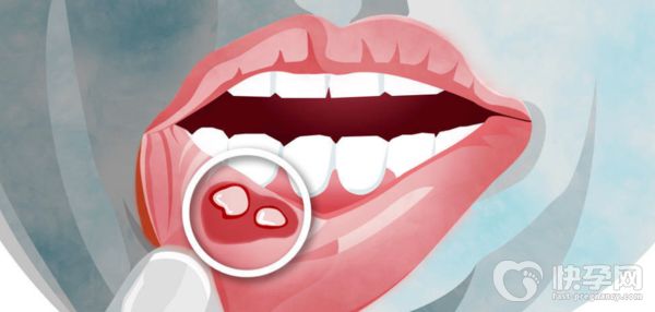 经常口腔溃疡的原因有哪些?经常口腔溃疡要如何调理？