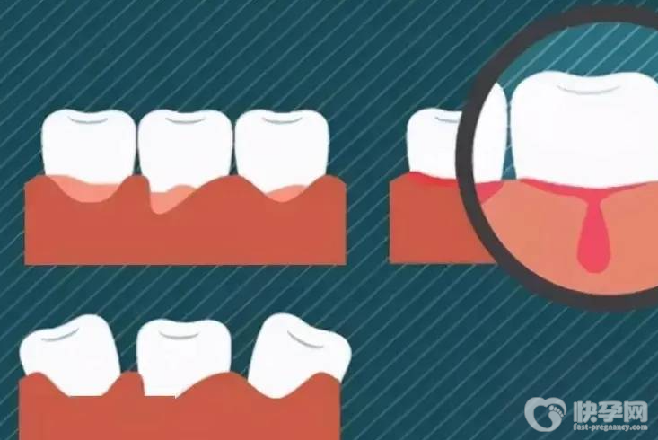 牙龈出血要警惕三种病，牙龈出血是什么原因呢