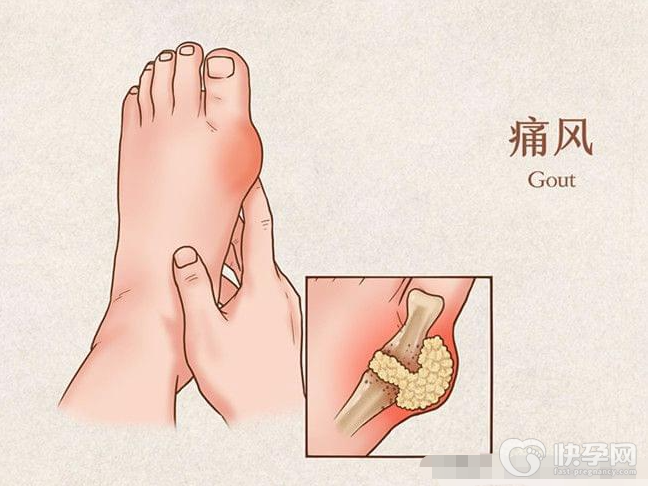 痛风一分钟止疼小妙招，缓解痛风的5个小妙招