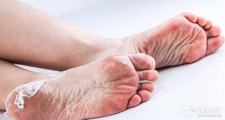 得了肝病脚会出现哪些症状？肝不好吃什么调理最好?