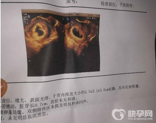 血块和孕囊的四个区别图解，轻松学会分辩血块和孕囊