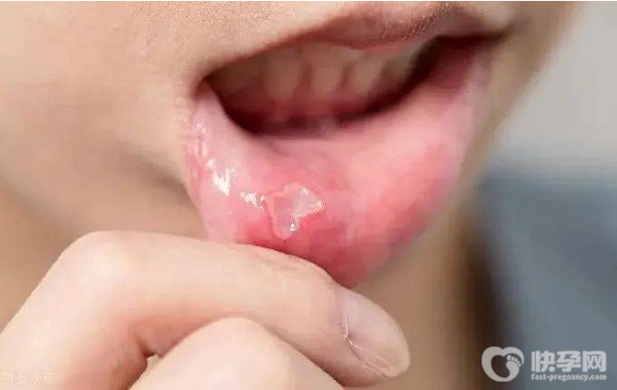 5个小妙招巧治口腔溃疡，一夜治好口腔溃疡的克星