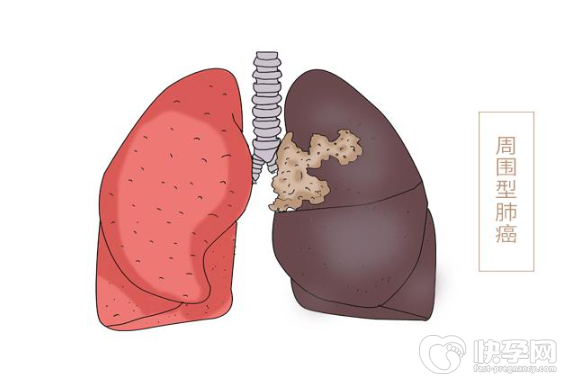 肺癌晚上睡觉的4个征兆，肺癌发出的求救信号你知道吗