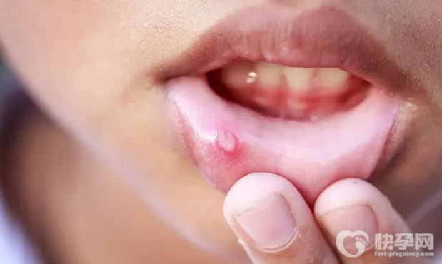 口腔溃疡三分钟见效,口腔溃疡最快的土办法