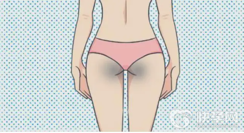去除臀部两块黑印妙招有哪些？屁股发黑是怎么回事？