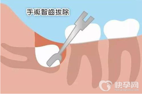 女士拔智齿的最佳时间，怎么判断智齿要不要拔?
