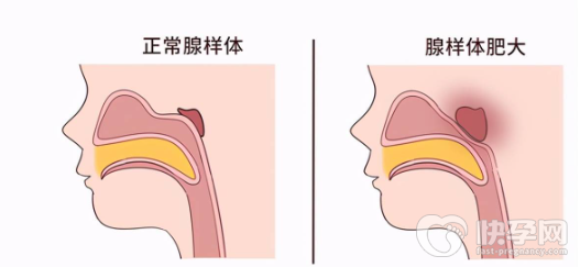腺样体肥大是什么症状？腺样体肥大要怎么办？