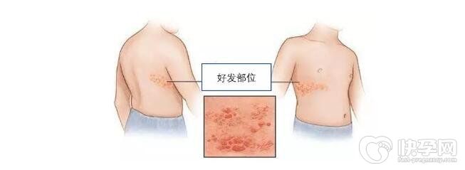 疱疹能彻底治好吗？疱疹要如何预防？